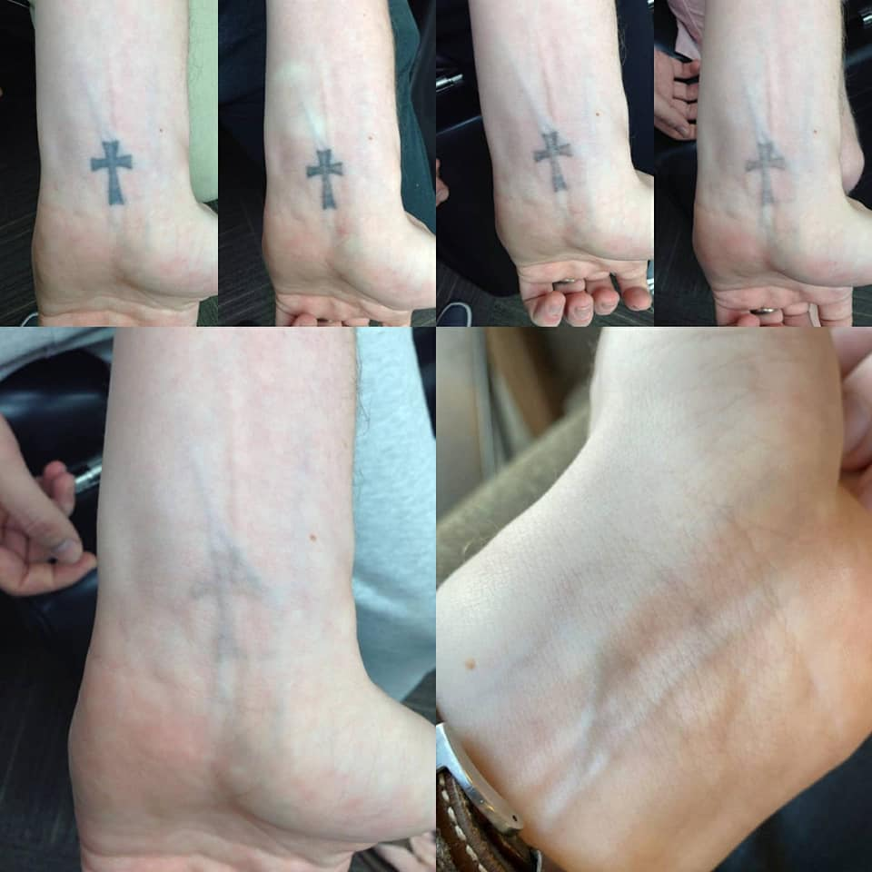 Before After Tattoo Removal After One Session