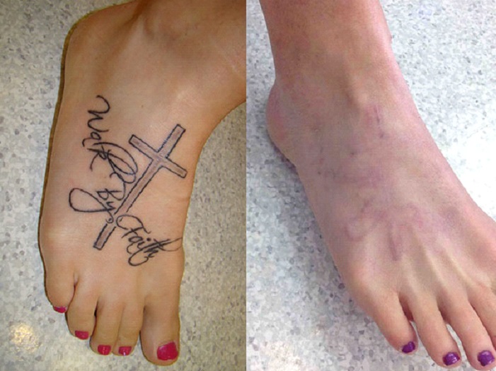 Everything You Need To Know About Tattoo Removal Before And After