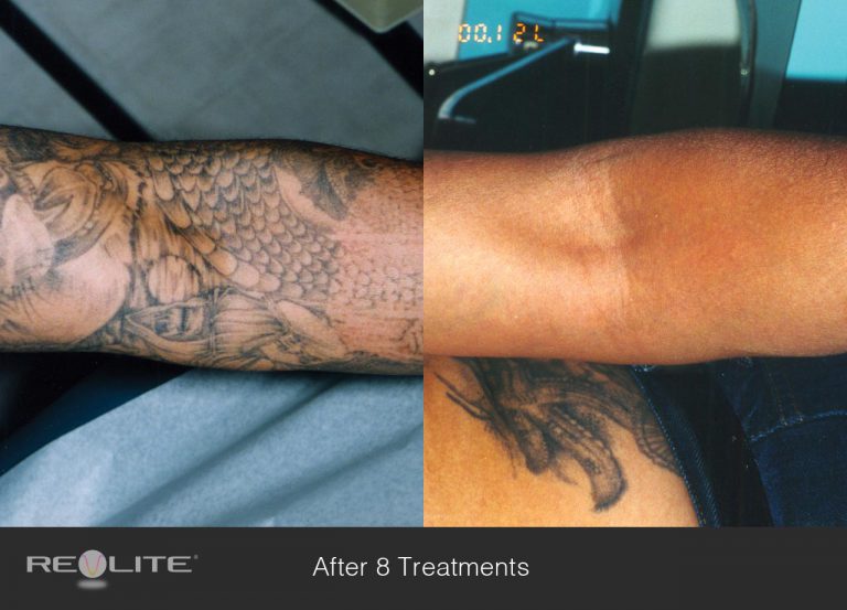 Laser Tattoo Removal Contour Dermatology