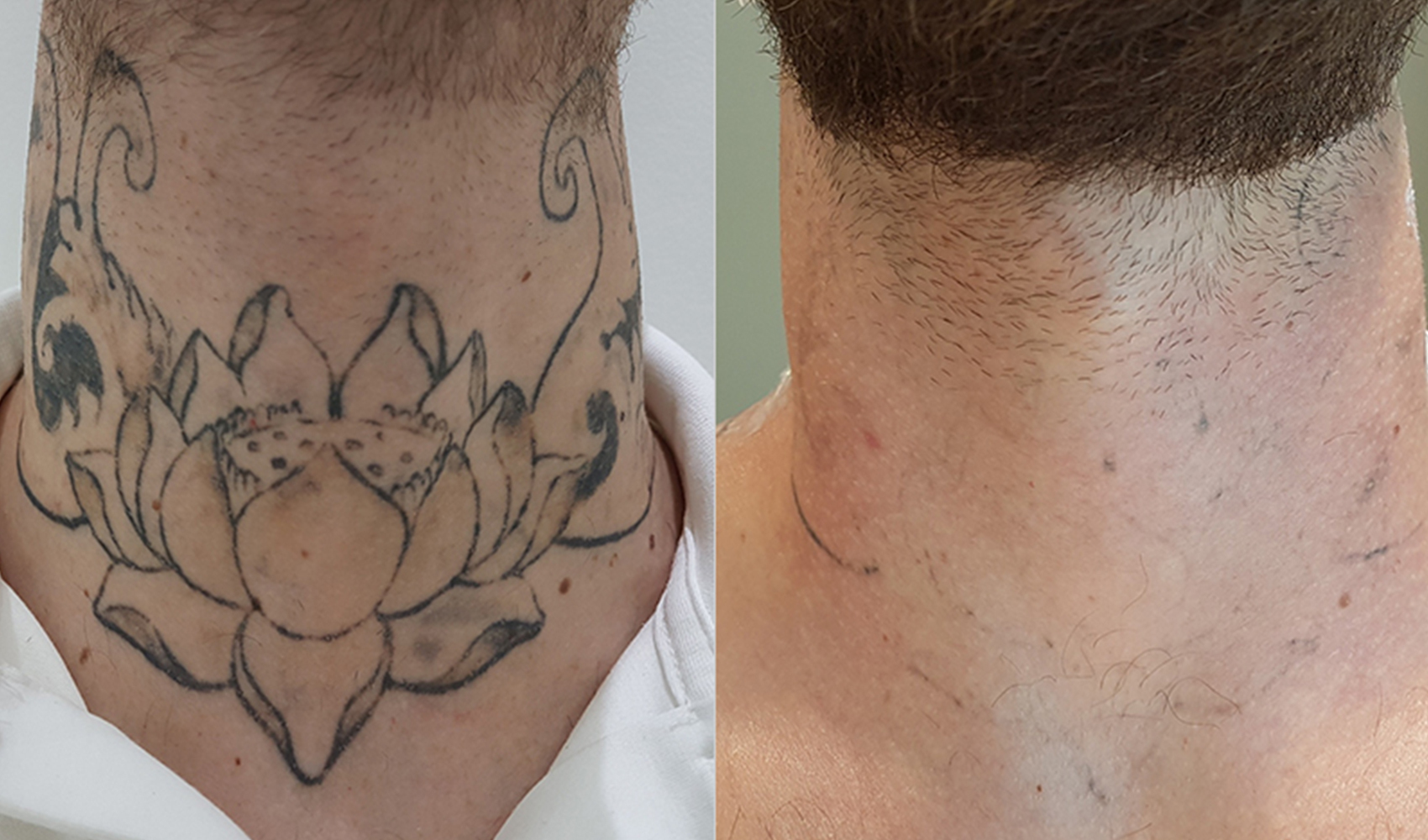 Tattoo Removal Dubai Medical Village