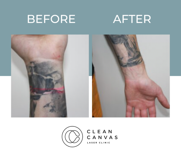 Tattoo Removal Prices In Sydney Clean Canvas Laser Clinic