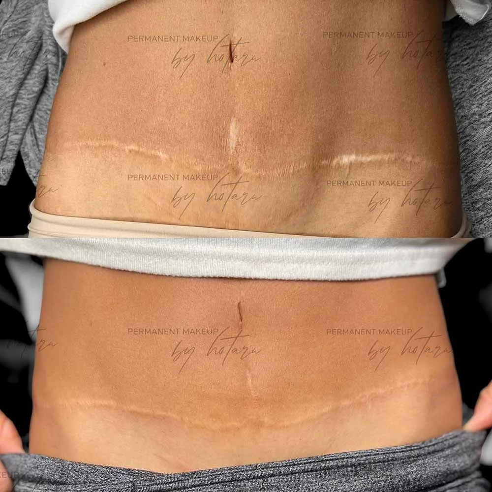 Tummy Tuck Tattoos 5 Tummy Tuck Information Prices Photos