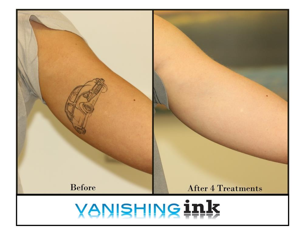 Vanishing Ink Tattoo Removal Clinic Review Ratings Information