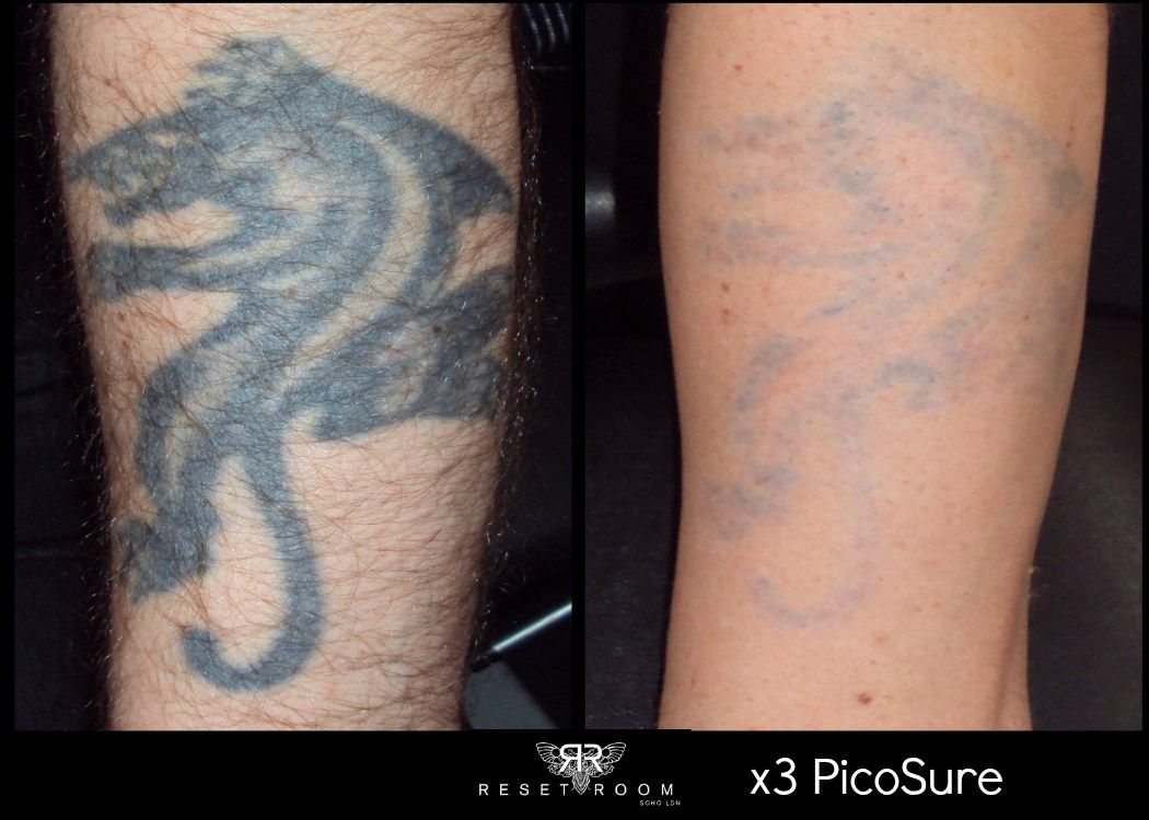 Wrecking Balm: Effective Tattoo Removal Solution